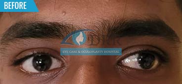 Squint Eye Treatment In Chennai