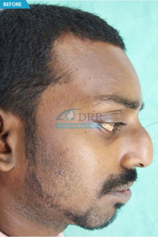 Rhinoplasty Treatment In Chennai