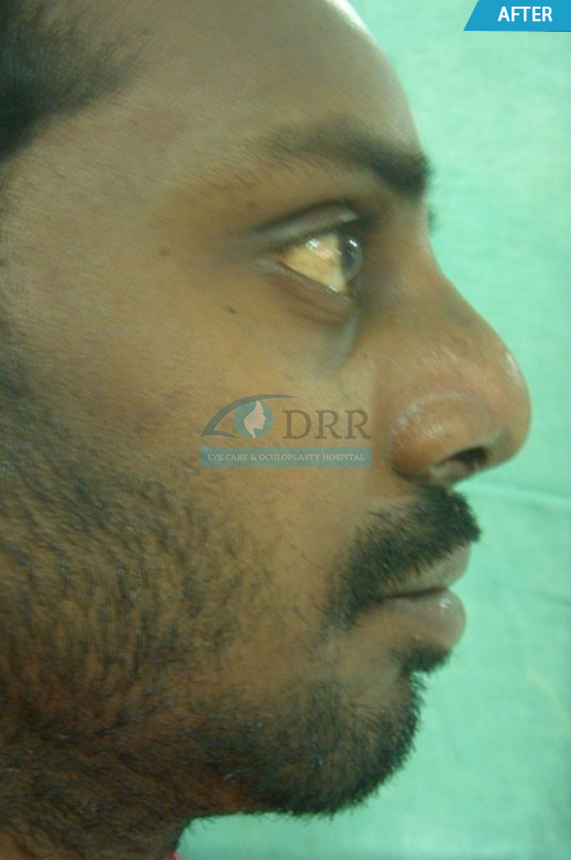 Rhinoplasty Treatment In Chennai