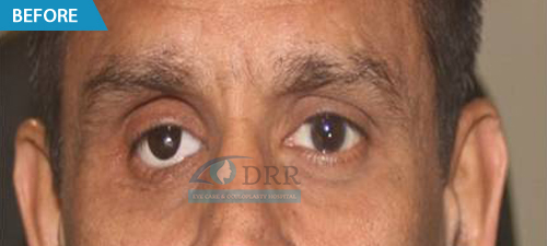 Artificial Eye Treatment Center In Chennai