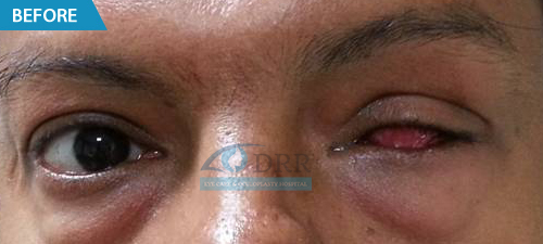 Artificial Eye Treatment Center In Chennai