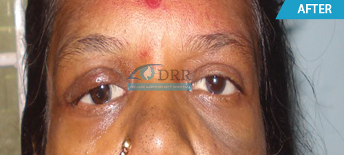 Congenital Eye Deformities Treatment In Chennai