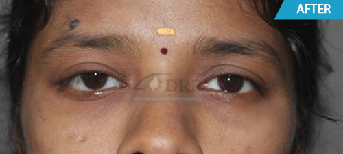 Ptosis Treatment In Chennai