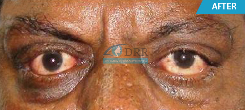 Thyroid Eye Disease Treatment In Chennai